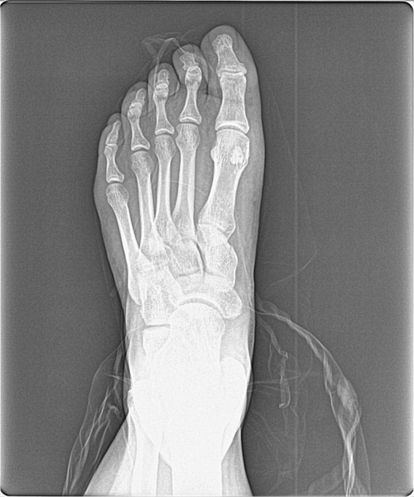 Podiatrist In Houston Tailor S Bunion In Houston Biel Foot Ankle Specialists